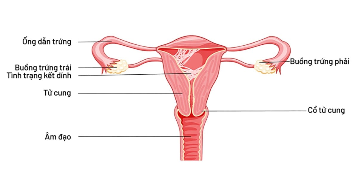 dinh buong tu cung la gi 1 min 2025 | Trung tâm hỗ trợ sinh sản IVF Bảo Sơn