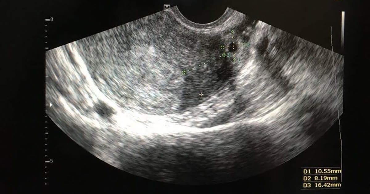 lam ivf co bi thai ngoai tu cung khong 1 2025 | Trung tâm hỗ trợ sinh sản IVF Bảo Sơn lam ivf co bi thai ngoai tu cung khong 1 2025 | Trung tâm hỗ trợ sinh sản IVF Bảo Sơn