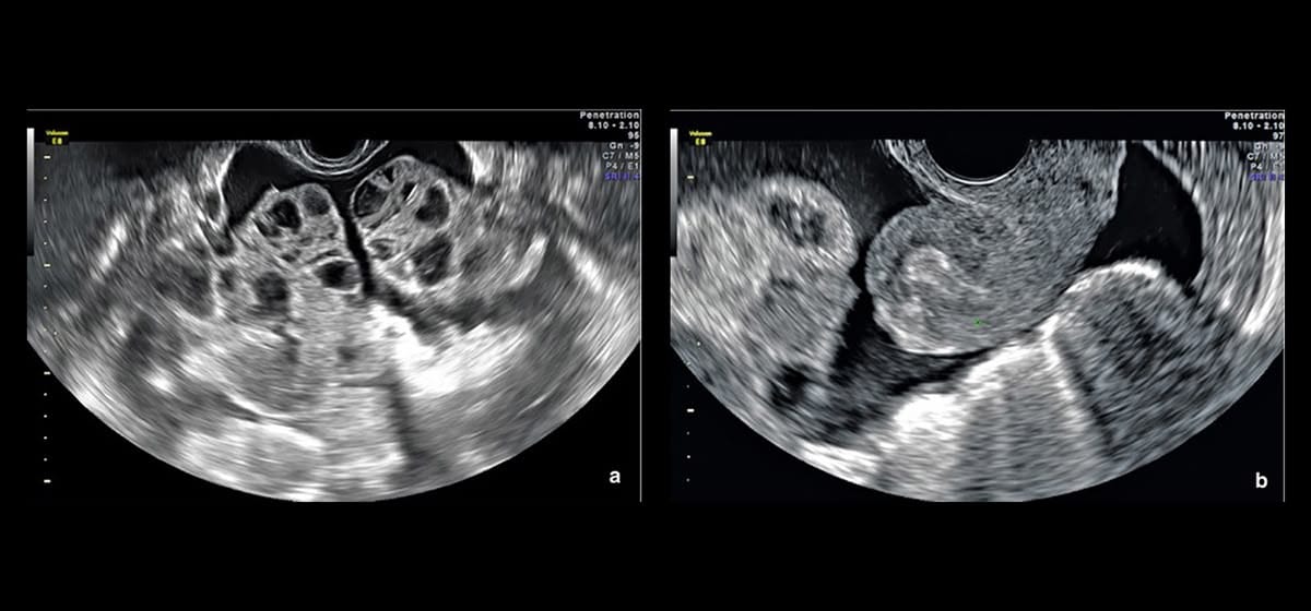 qua kich buong trung hieu ro de phong tranh 1 2025 | Trung tâm hỗ trợ sinh sản IVF Bảo Sơn