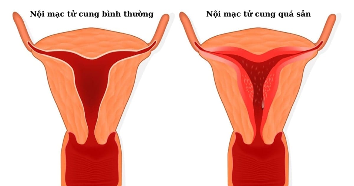 qua san niem mac tu cung co thai duoc khong 1 min 2025 | Trung tâm hỗ trợ sinh sản IVF Bảo Sơn