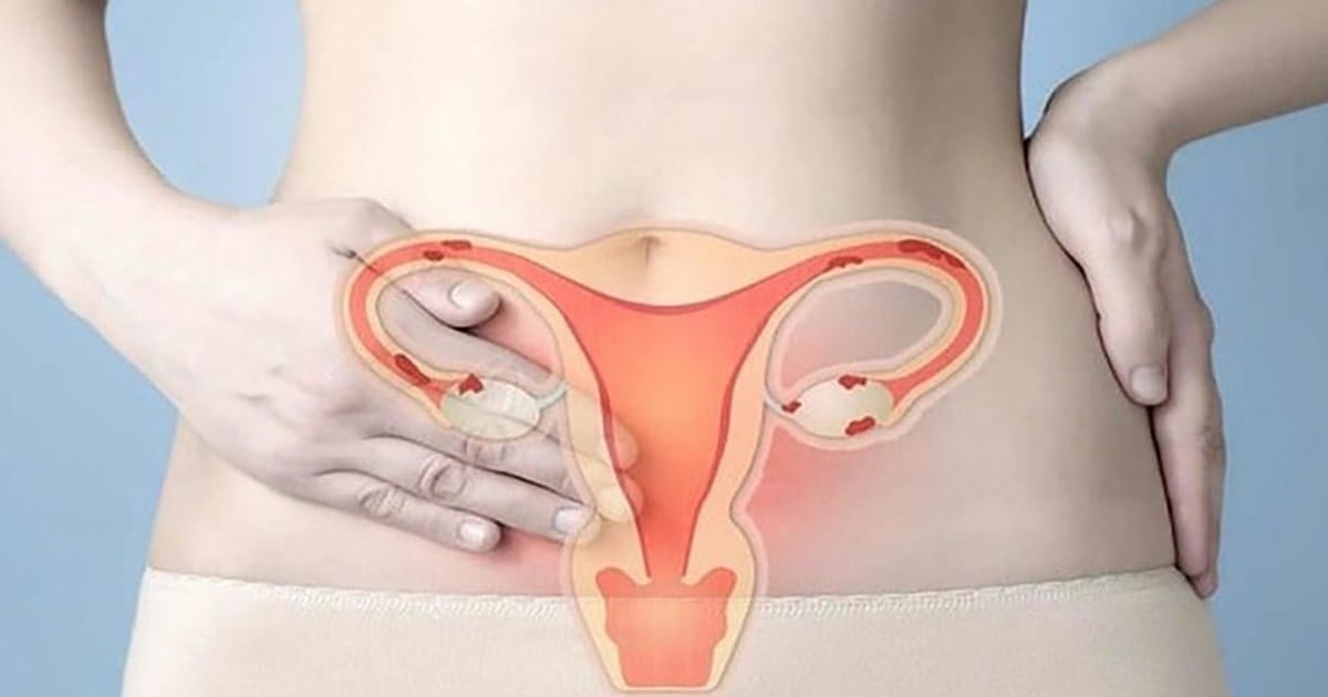 qua san niem mac tu cung co thai duoc khong 2 min 2025 | Trung tâm hỗ trợ sinh sản IVF Bảo Sơn