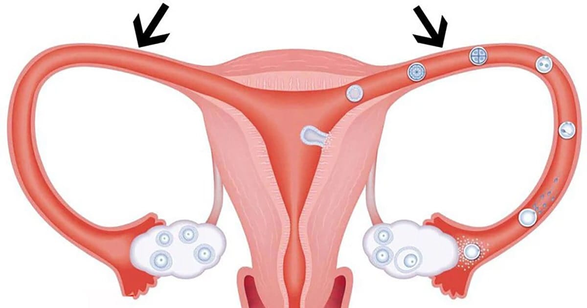 tac voi trung co thai tu nhien duoc khong 1 min 2025 | Trung tâm hỗ trợ sinh sản IVF Bảo Sơn