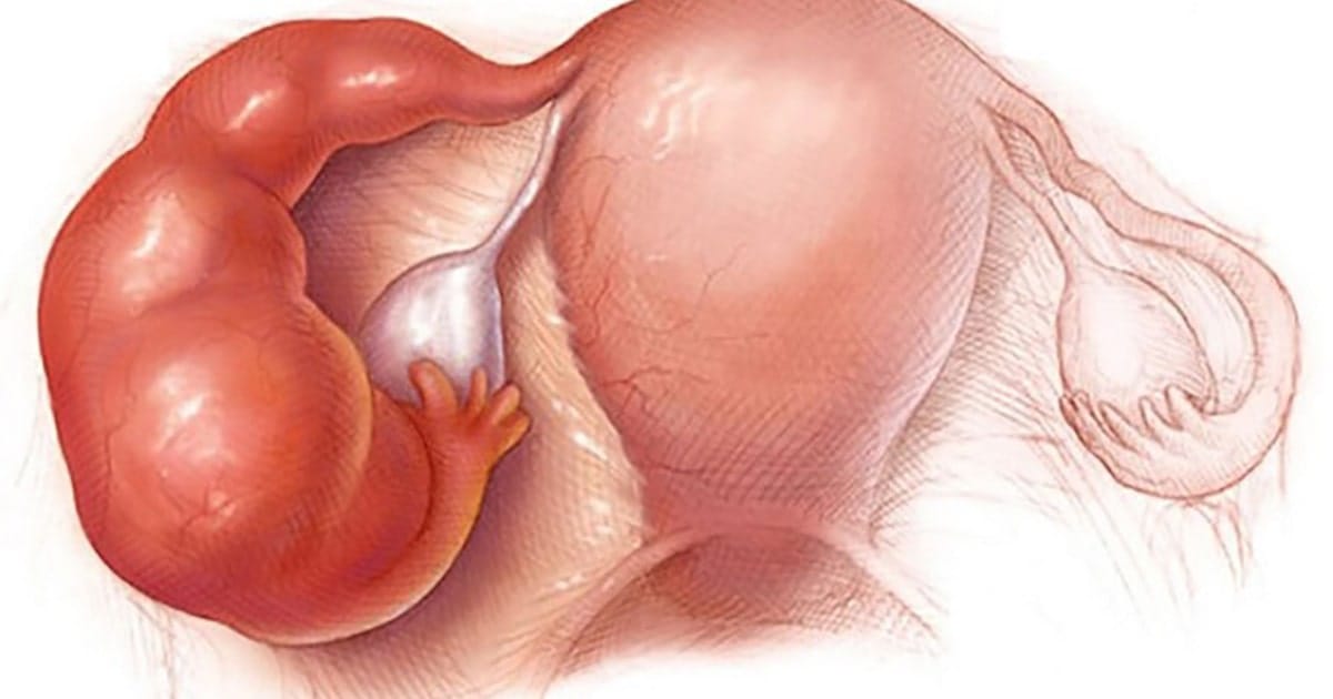 u dich voi trung la gi 1 min 2025 | Trung tâm hỗ trợ sinh sản IVF Bảo Sơn