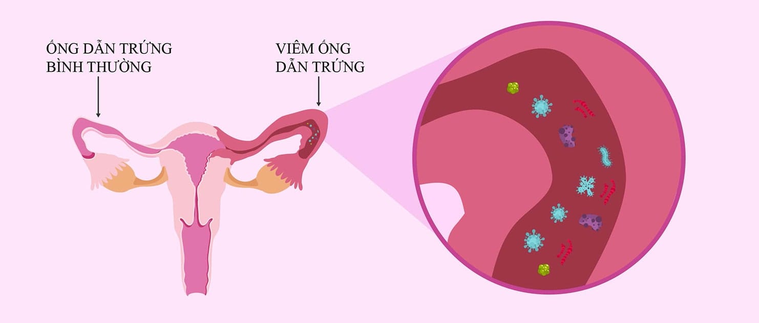viem voi trung la gi 1 min 2025 | Trung tâm hỗ trợ sinh sản IVF Bảo Sơn