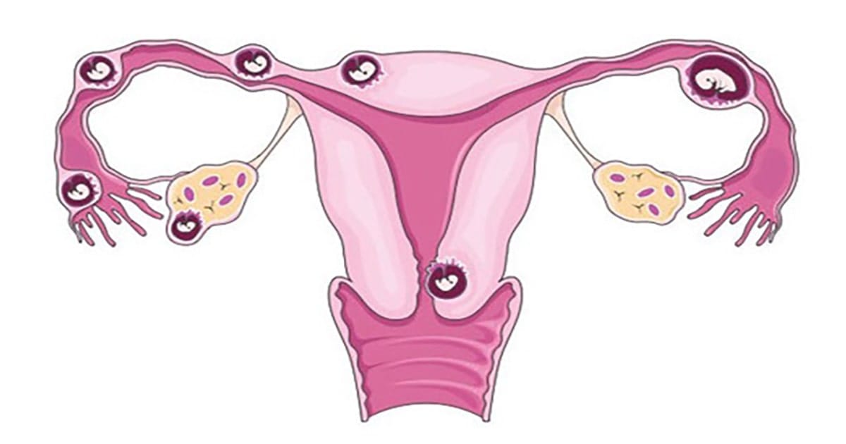 viem voi trung la gi 2 min 2025 | Trung tâm hỗ trợ sinh sản IVF Bảo Sơn